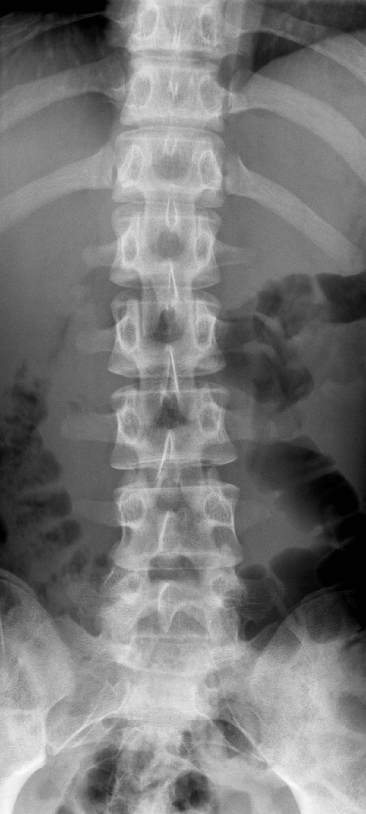 Lumbar Spine Radiographic Anatomy My Xxx Hot Girl 8687